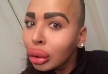 ‘The Lip King’s’ dark life from surgery ‘sex’ claim to BBL death and illegal jabs