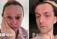 Our skin is falling off and no-one can tell us why