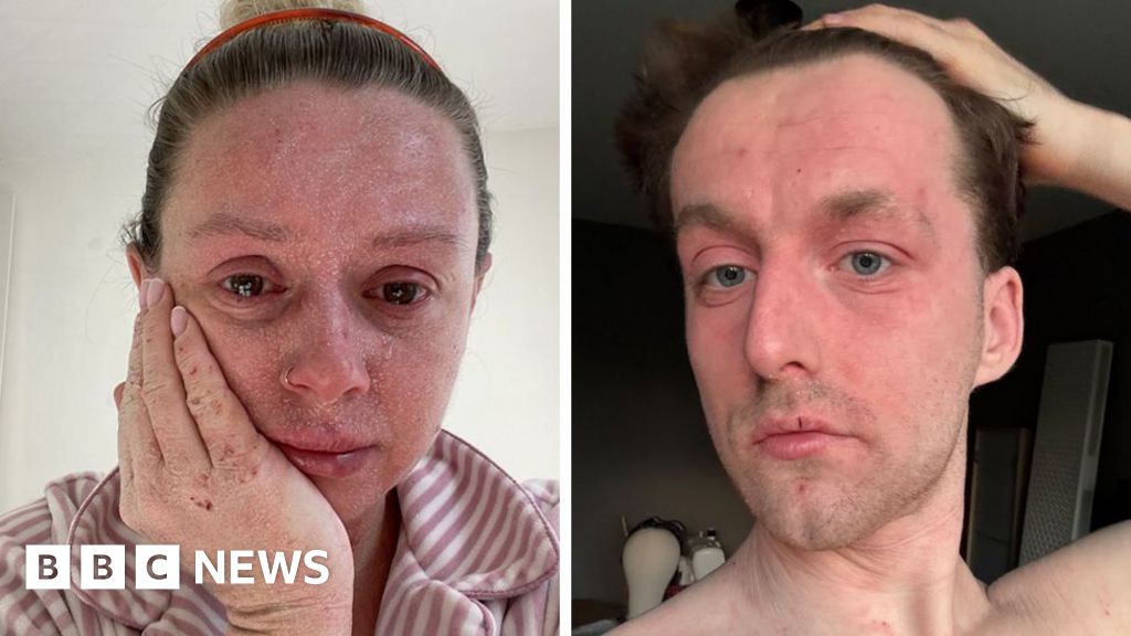 Our skin is falling off and no-one can tell us why