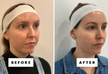 XERF Is the New Non-Invasive Skin-Tightening Device Gaining Popularity in the US, and I Tried It—Review, Photos