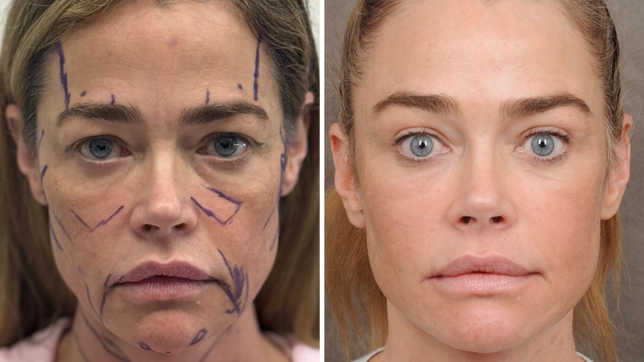 Denise Richards’ Raw Facelift Before-and-After Photos Are the Transparency We Need