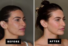 I Tried Facial Fat Grafting and 6 Months Later, I’m Very Into My Results