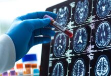 Blood test could detect Alzheimer’s and Parkinson’s 17 years early