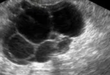 A Gyneac Explains Why PCOS Was Renamed And What It Means For Women