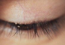Eyelash Mites: Symptoms, Causes, and How to Treat Them