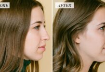 My Rhinoplasty Procedure Story | Nose Before and After Photos