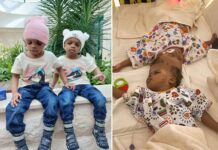 Conjoined twins separated after 19 months with fused skulls see each other for first time