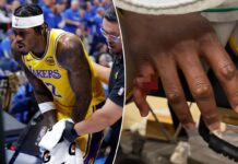 Lakers’ Jarred Vanderbilt shares graphic photos of gruesome finger injury: ‘Looks like a chicken wing’