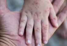 أسوأ تفشٍ منذ 35 عاما.. مستوى غير مسبوق لإصابات الحصبة في أمريكا