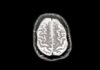 RFK Jr urges Alzheimer’s screening but blunts key panel that could drive research