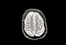 RFK Jr urges Alzheimer’s screening but blunts key panel that could drive research