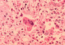 Measles: Myth Vs. Fact