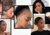 More Women Are Getting Hair Transplants in Turkey