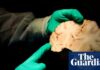 New study estimates 75% of deceased ex-NFL players had brain disease CTE