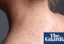 Pennsylvania faces largest measles outbreak in decades as case count rises to 1,000