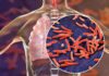 Iran makes progress in tuberculosis control, but gaps in case detection remain