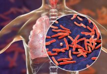 Iran makes progress in tuberculosis control, but gaps in case detection remain