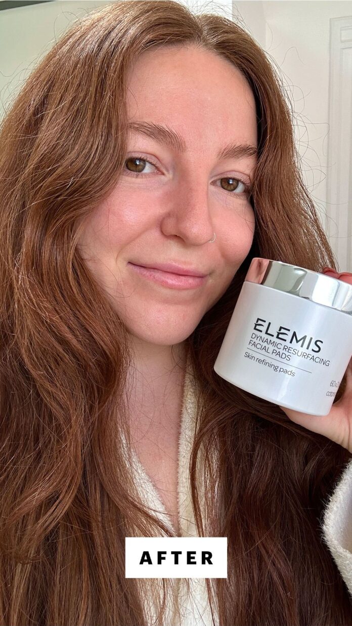 Elemis%2520Dynamic%2520Resurfacing%2520Pads%2520Lizzy%2520after.jpg