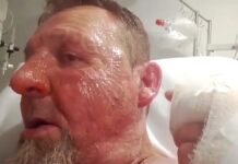 Hospital patient charged with attempted murder for setting another patient on fire